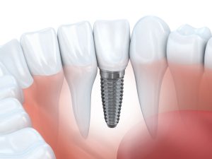dental implants in the capital district offer a sturdy solution